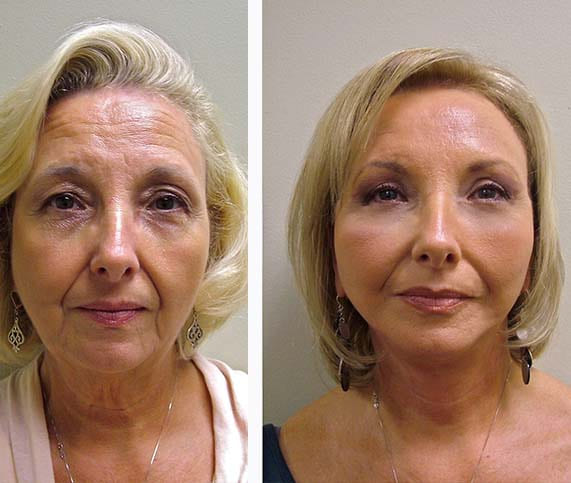 Before/After Kállay Amália