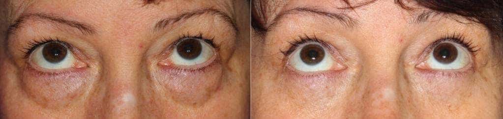 Before/After Kállay Amália